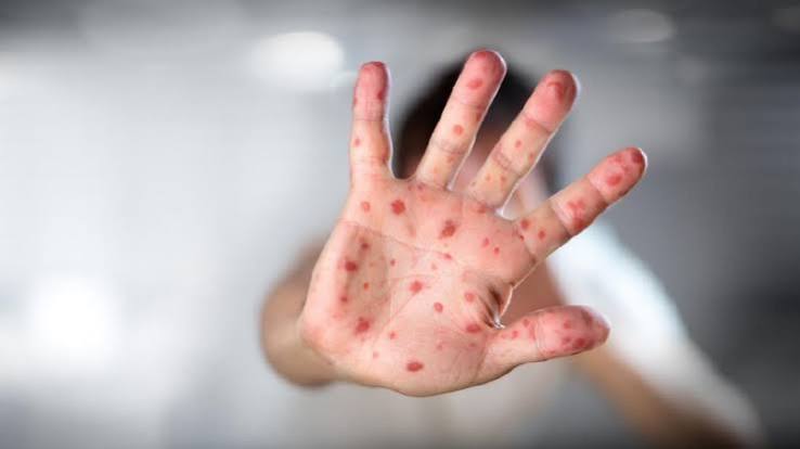 2026 Measles Outbreak: Why the World Needs More Public Health Professionals
